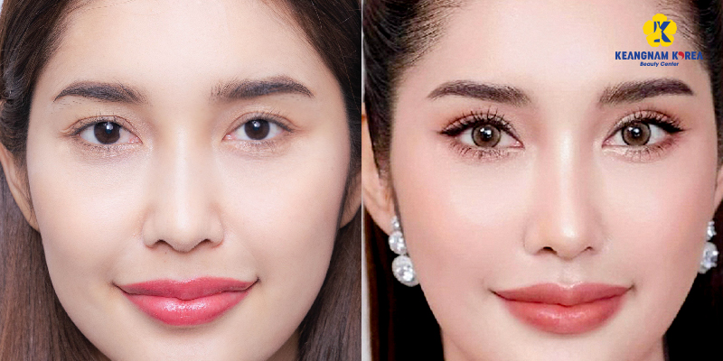 Asymmetrical Eye Surgery Cost: Cause, Method, Cost and Treatment Guide 6 asymmetric eye correction cost 6