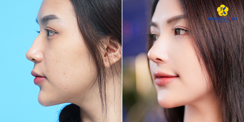 What Cosmetic Surgery Fits a Tet Trip to Vietnam? 3 What Cosmetic Surgery Fits a Tet Trip to Vietnam?