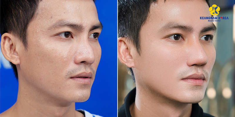 What Cosmetic Surgery Fits a Tet Trip to Vietnam? 5 What Cosmetic Surgery Fits a Tet Trip to Vietnam?