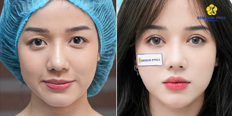 What Cosmetic Surgery Fits a Tet Trip to Vietnam? 4 What Cosmetic Surgery Fits a Tet Trip to Vietnam?