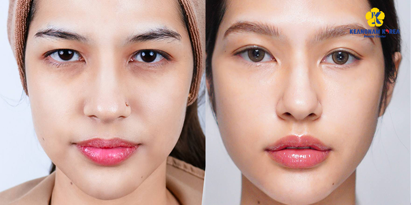How Much Does Double Eyelid Surgery Cost in Ho Chi Minh City? 2026 Asian Blepharoplasty Price List at Keangnam Korea 3 double eyelid surgery cost before and after