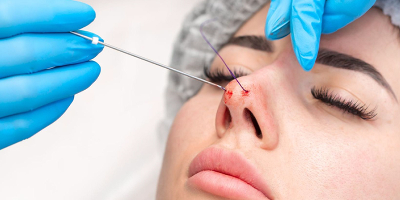 liquid nose job