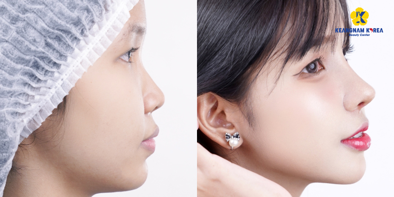 liquid nose job