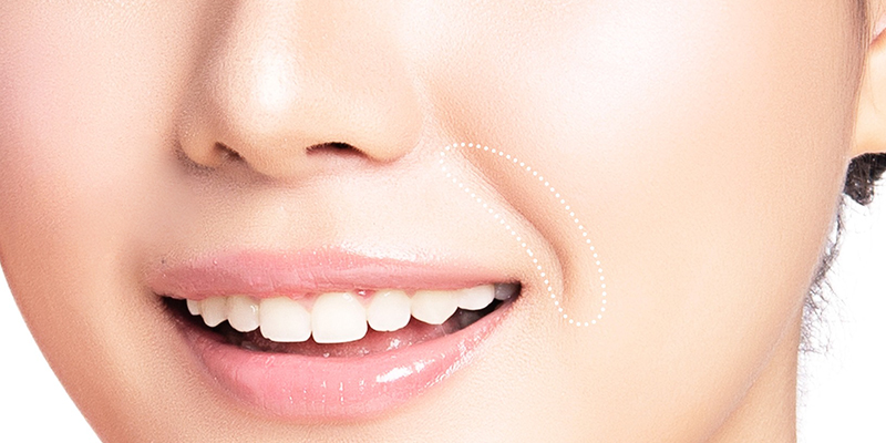 Smile Lines Treatment Cost 2026: Nasolabial Fold Removal Prices in Vietnam 1 Smile Lines Treatment Cost 2026