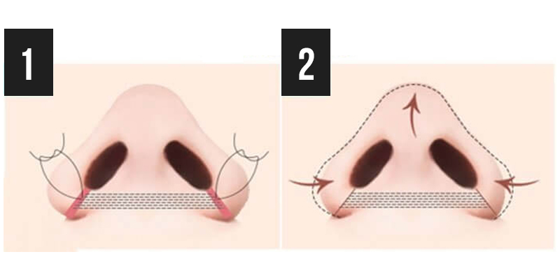 Alar Base Reduction Cost 2026: Pricing Guide, Methods & What to Know Before Surgery in Ho Chi Minh City 2 Alar Base Reduction Cost 2026