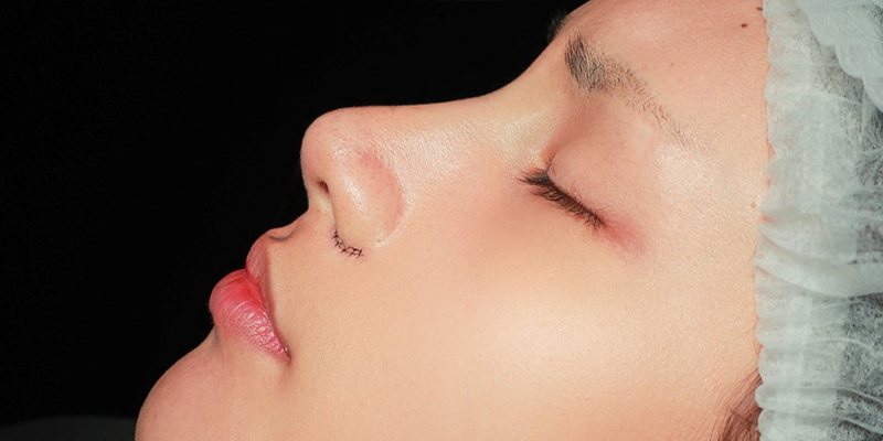 Alar Base Reduction Cost 2026: Pricing Guide, Methods & What to Know Before Surgery in Ho Chi Minh City 1 Alar Base Reduction Cost 2026