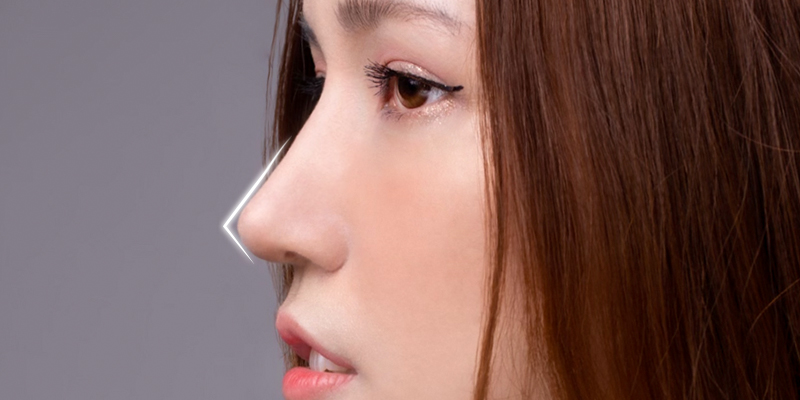 S-Line vs L-Line Rhinoplasty Comparison, Which Nose Shape Suits You? 3 L-Line rhinoplasty