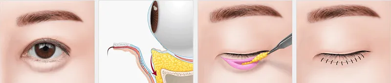How much does Lower Eyelid Fat Removal in Ho Chi Minh? 2026 Cost & Recovery Guide 2 lower eyelid fat removal 1