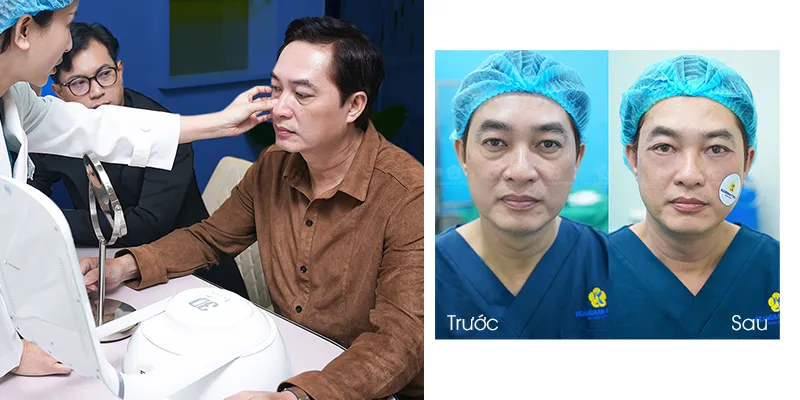 How much does Lower Eyelid Fat Removal in Ho Chi Minh? 2026 Cost & Recovery Guide 4 lower eyelid fat removal 3