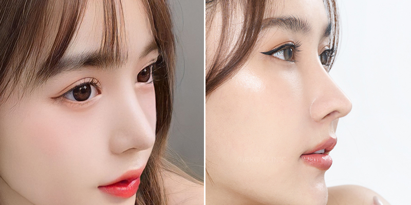 S-Line vs L-Line Rhinoplasty Comparison, Which Nose Shape Suits You? 4 S-Line vs L-Line rhinoplasty