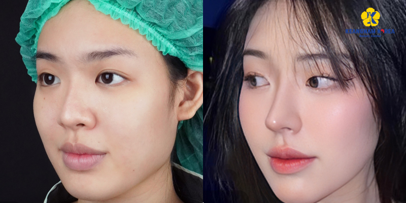 S-Line vs L-Line Rhinoplasty Comparison, Which Nose Shape Suits You? 6 S-Line vs L-Line rhinoplasty