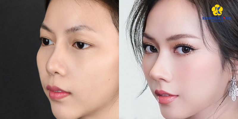 S-Line vs L-Line Rhinoplasty Comparison, Which Nose Shape Suits You? 7 S-Line vs L-Line rhinoplasty