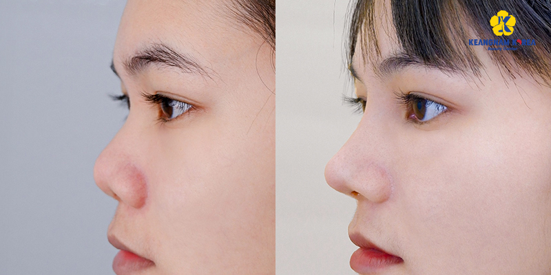 Structural Rhinoplasty: What It Is, Cost, and How It Compares in 2026 2 structural rhinoplasty 1 1