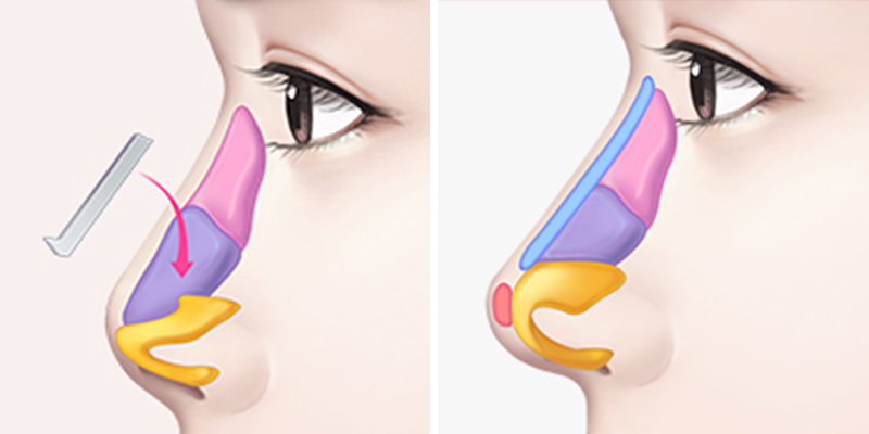 Structural Rhinoplasty vs. Semi-Structural Rhinoplasty: Differences, Costs, and Which to Choose 2 Structural Rhinoplasty vs. Semi-Structural Rhinoplasty