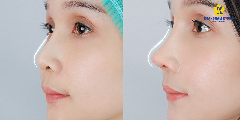 Structural Rhinoplasty: What It Is, Cost, and How It Compares in 2026 3 structural rhinoplasty 2