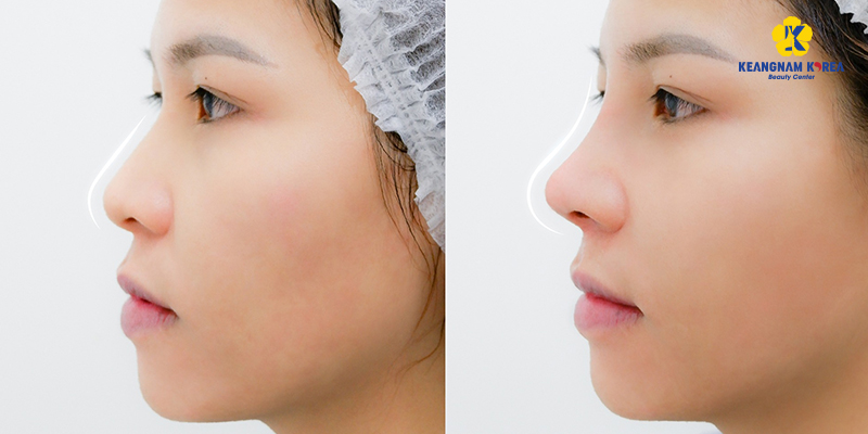 Structural Rhinoplasty: What It Is, Cost, and How It Compares in 2026 5 structural rhinoplasty 4