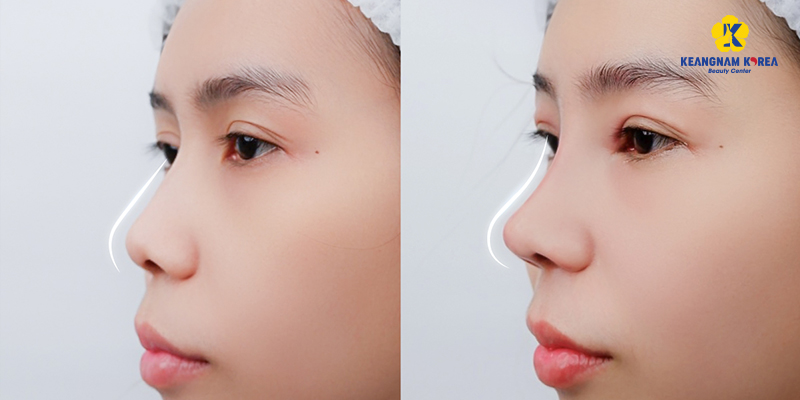 Structural Rhinoplasty: What It Is, Cost, and How It Compares in 2026 6 structural rhinoplasty 5