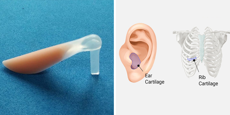 Structural Rhinoplasty vs. Semi-Structural Rhinoplasty: Differences, Costs, and Which to Choose 3 Structural Rhinoplasty vs. Semi-Structural Rhinoplasty