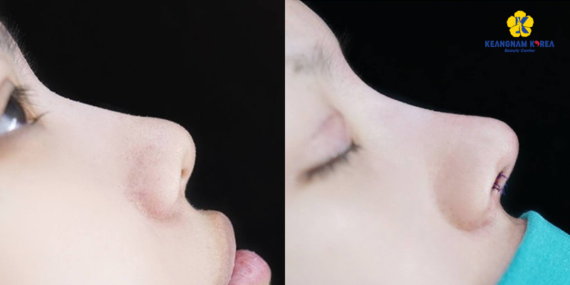 Structural Rhinoplasty vs. Semi-Structural Rhinoplasty: Differences, Costs, and Which to Choose 4 Structural Rhinoplasty vs. Semi-Structural Rhinoplasty