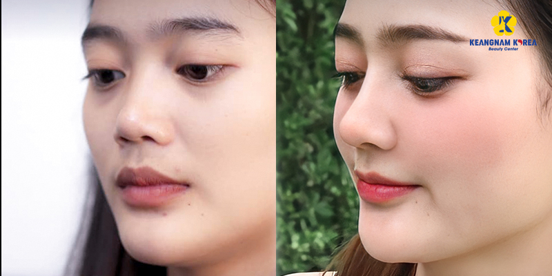 Structural Rhinoplasty vs. Semi-Structural Rhinoplasty: Differences, Costs, and Which to Choose 5 Structural Rhinoplasty vs. Semi-Structural Rhinoplasty