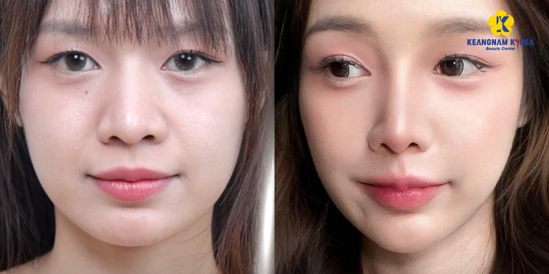 Structural Rhinoplasty vs. Semi-Structural Rhinoplasty: Differences, Costs, and Which to Choose 1 Structural Rhinoplasty vs. Semi-Structural Rhinoplasty