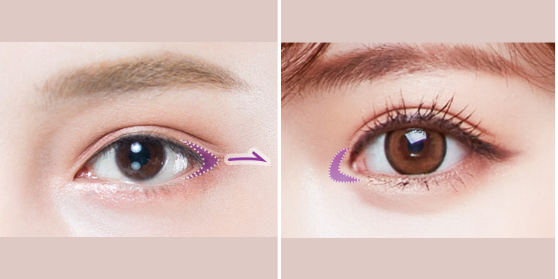 Canthoplasty Cost in Vietnam 2026 3 Canthoplasty Cost in Vietnam 2026