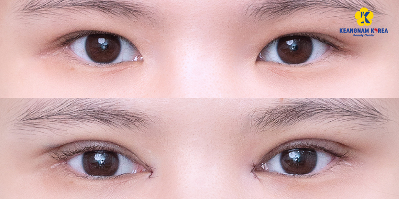 Canthoplasty Cost in Vietnam 2026 4 Canthoplasty Cost in Vietnam 2026