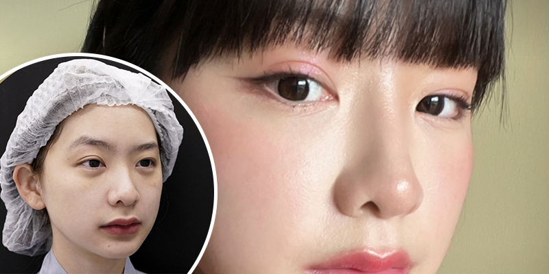 Canthoplasty Cost in Vietnam 2026 2 Canthoplasty Cost in Vietnam 2026