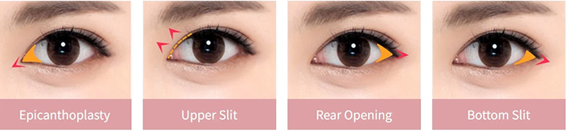 Eye Widening Surgery Cost in Vietnam 2026 2 Eye Widening Surgery Cost in Vietnam 2026