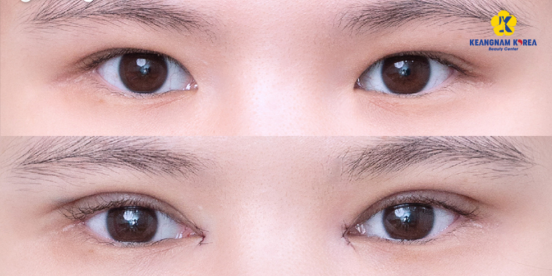 Eye Widening Surgery Cost in Vietnam 2026 3 Eye Widening Surgery Cost in Vietnam 2026