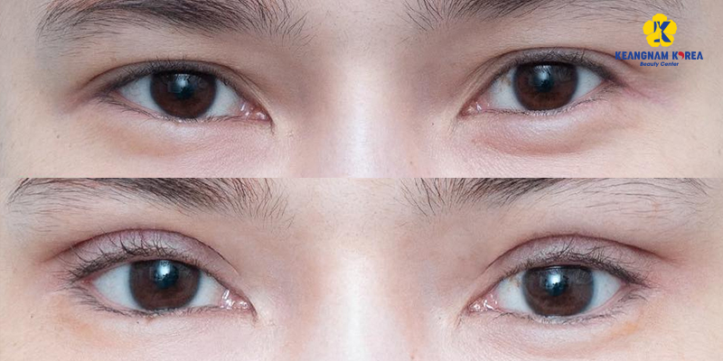 Eye Widening Surgery Cost in Vietnam 2026 4 Eye Widening Surgery Cost in Vietnam 2026
