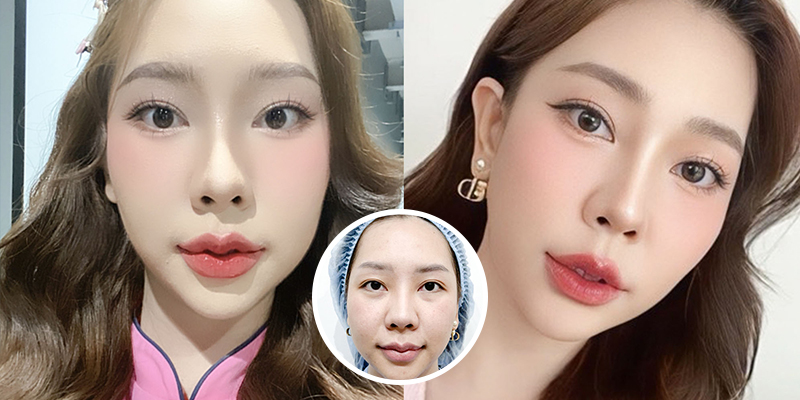 Eye Widening Surgery Cost in Vietnam 2026 5 Eye Widening Surgery Cost in Vietnam 2026
