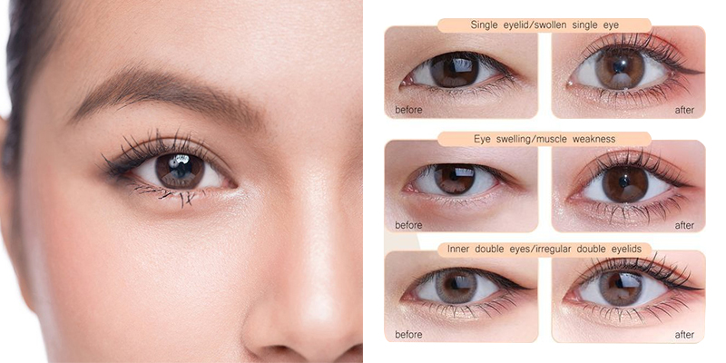 Eye Widening Surgery Cost in Vietnam 2026 1 Eye Widening Surgery Cost in Vietnam 2026