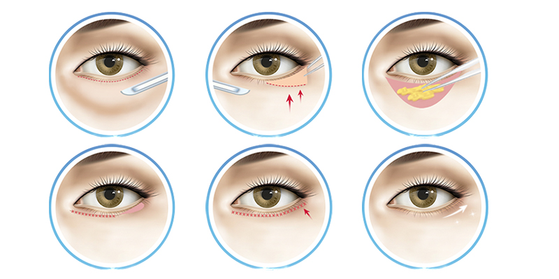 Lower Blepharoplasty Cost in Vietnam: Cosmetic Surgery Guide & 2026 Price List 2 Lower Blepharoplasty Cost in Vietnam 2026