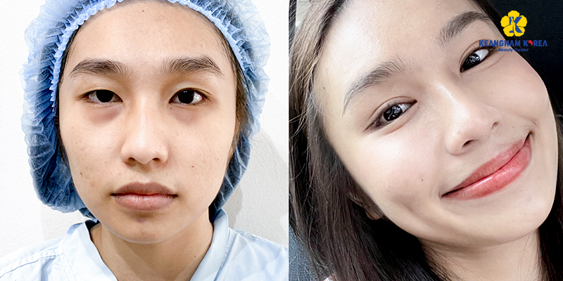 Lower Blepharoplasty Cost in Vietnam: Cosmetic Surgery Guide & 2026 Price List 3 Lower Blepharoplasty Cost in Vietnam 2026