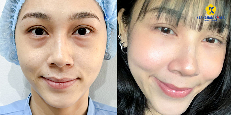 Lower Blepharoplasty Cost in Vietnam: Cosmetic Surgery Guide & 2026 Price List 4 Lower Blepharoplasty Cost in Vietnam 2026