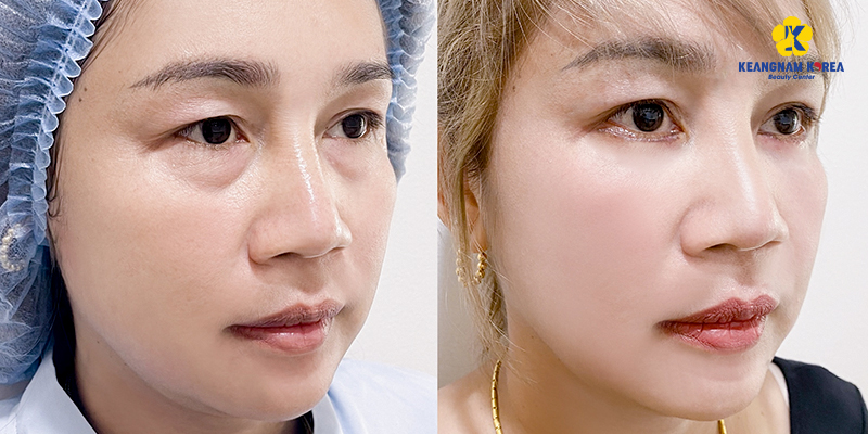 Lower Blepharoplasty Cost in Vietnam: Cosmetic Surgery Guide & 2026 Price List 5 Lower Blepharoplasty before after