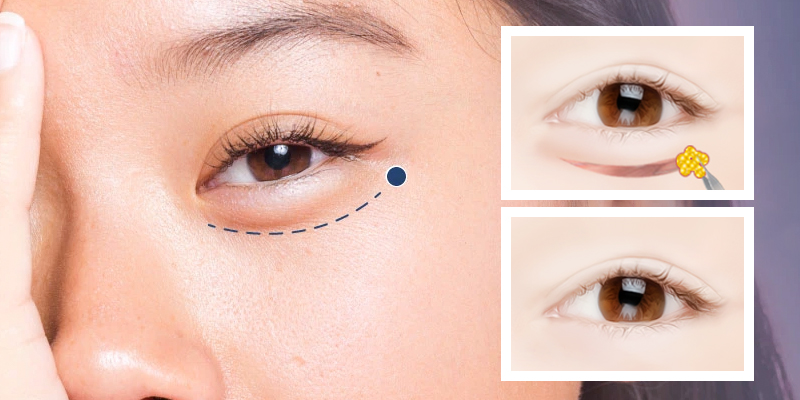 Lower Blepharoplasty Cost in Vietnam: Cosmetic Surgery Guide & 2026 Price List 1 Lower Blepharoplasty Cost in Vietnam