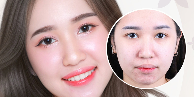 Non-Incisional Double Eyelid Surgery Cost: 2026 Price Guide for Suture and Plasma Methods in Vietnam 2 Non-Incisional Double Eyelid Surgery Cost