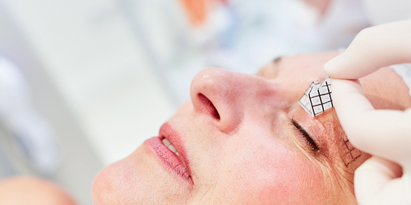 Non-Incisional Double Eyelid Surgery Cost: 2026 Price Guide for Suture and Plasma Methods in Vietnam 3 Non-Incisional Double Eyelid Surgery Cost