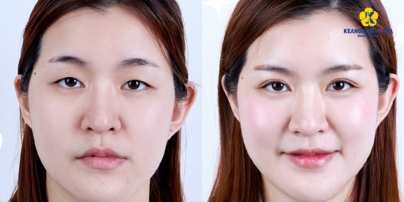 Non-Incisional Double Eyelid Surgery Cost: 2026 Price Guide for Suture and Plasma Methods in Vietnam 5 Non-Incisional Double Eyelid Surgery Cost
