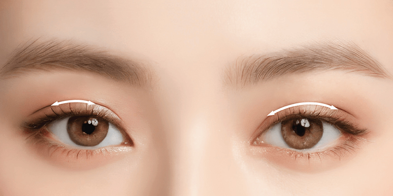 Non-Incisional Double Eyelid Surgery Cost: 2026 Price Guide for Suture and Plasma Methods in Vietnam 1 Non-Incisional Double Eyelid Surgery Cost