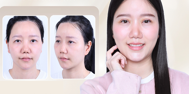 Droopy Eyelid: Causes, How to Fix It, and Surgery Cost in Vietnam 2026 2 one droopy eyelid