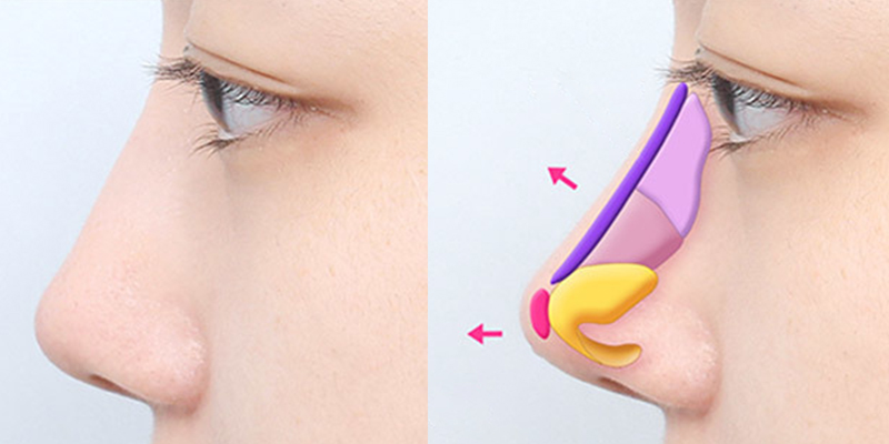 Revision Rhinoplasty Cost 2026: How Much Is It to Fix a Botched Nose Job in Vietnam? 3 revision rhinoplasty cost 1