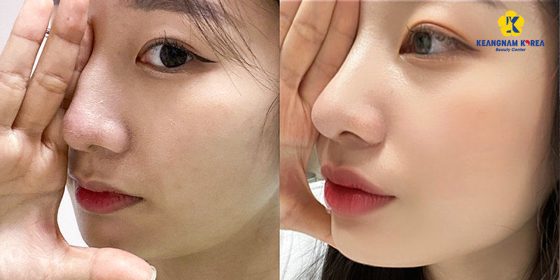 Revision Rhinoplasty Cost 2026: How Much Is It to Fix a Botched Nose Job in Vietnam? 4 revision rhinoplasty cost 3