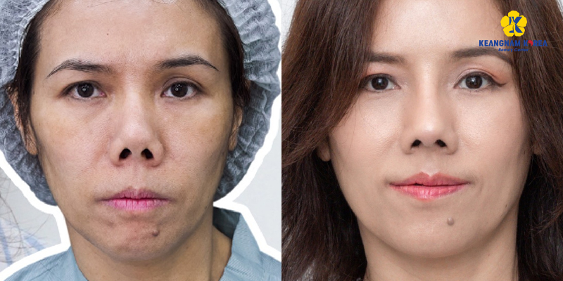 Revision Rhinoplasty Cost 2026: How Much Is It to Fix a Botched Nose Job in Vietnam? 5 revision rhinoplasty cost 4
