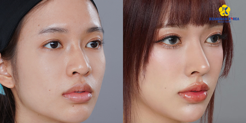 Rhinoplasty Cost in 2026: The Average Nose Job Price by Type in Vietnam 5 rhinoplasty cost 4