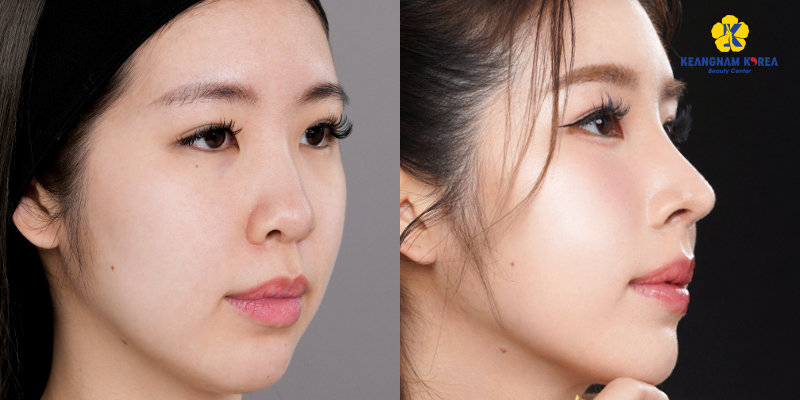 Rhinoplasty Cost in 2026: The Average Nose Job Price by Type in Vietnam 4 Rhinoplasty Cost in 2026