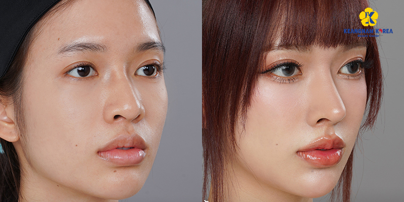 Rib Cartilage Rhinoplasty Cost in Vietnam 2026 5 Rib Cartilage Rhinoplasty Cost
