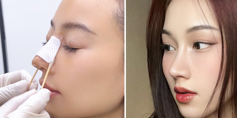 S-Line Rhinoplasty Cost 2026: The Complete Guide to Korean Nose Job Prices In Vietnam 4 S-Line Rhinoplasty Cost 2026
